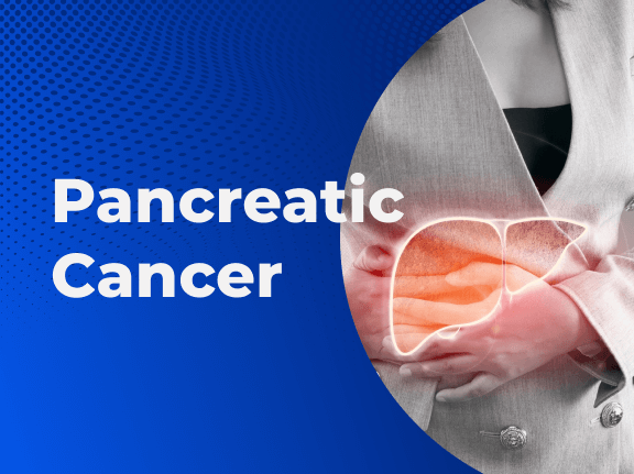 Pancreatic Cancer Basics