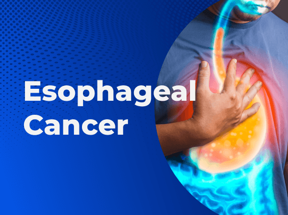 Esophageal Cancer Basics