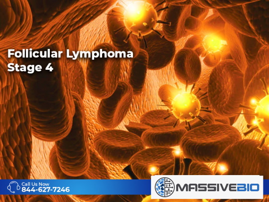 Follicular Lymphoma Stage 4