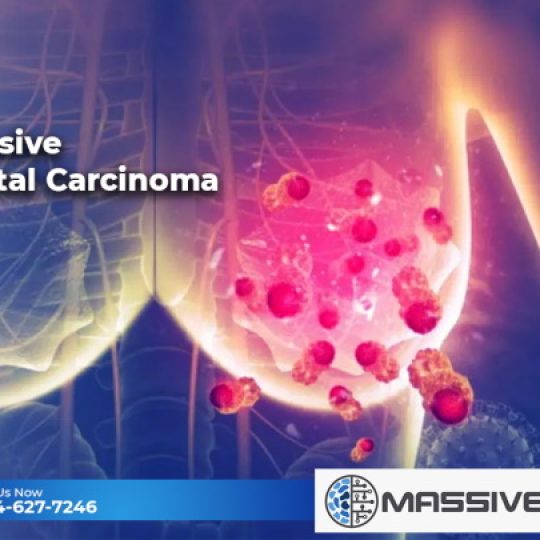 Invasive Ductal Carcinoma Treatment