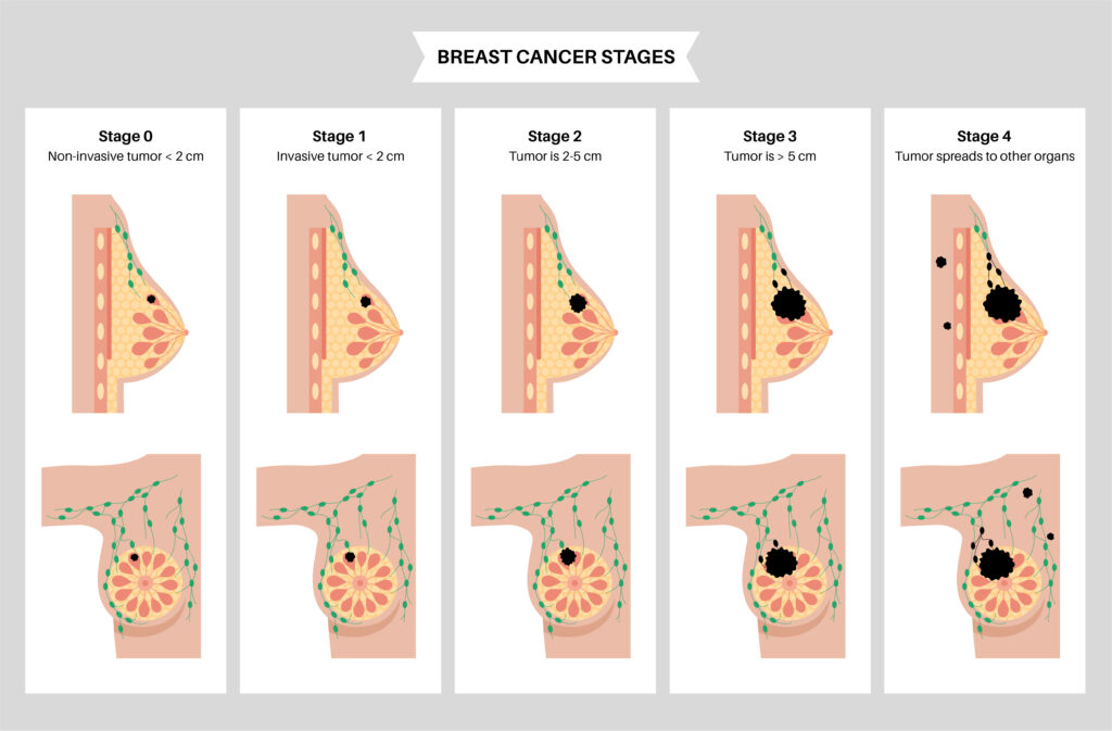 Breast cancer stages and tumor types