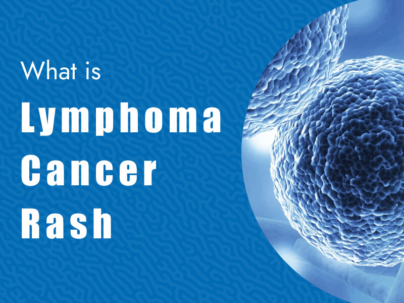 What is Lymphoma Cancer Rash