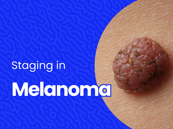 Staging in melanoma