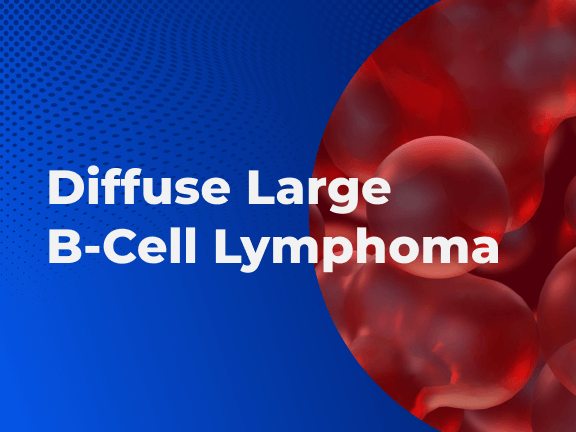 Diffuse Large B-Cell Lymphoma