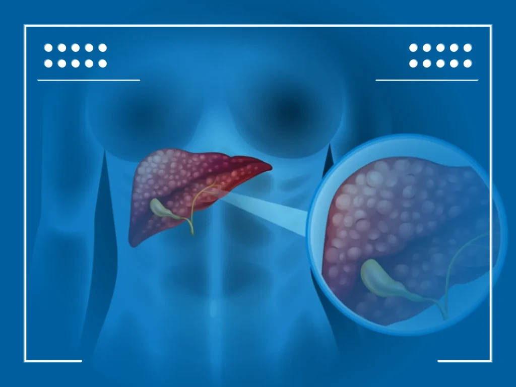 Metastasis en el Higado