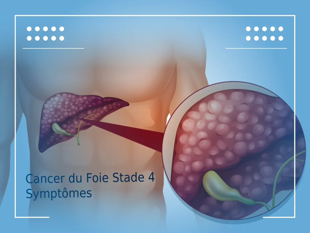 Cancer du foie stade 4 symptômes