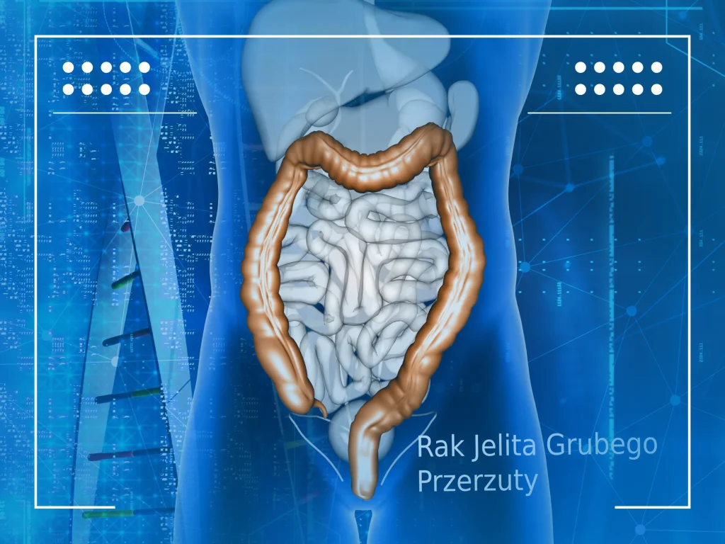 Rak jelita grubego przerzuty