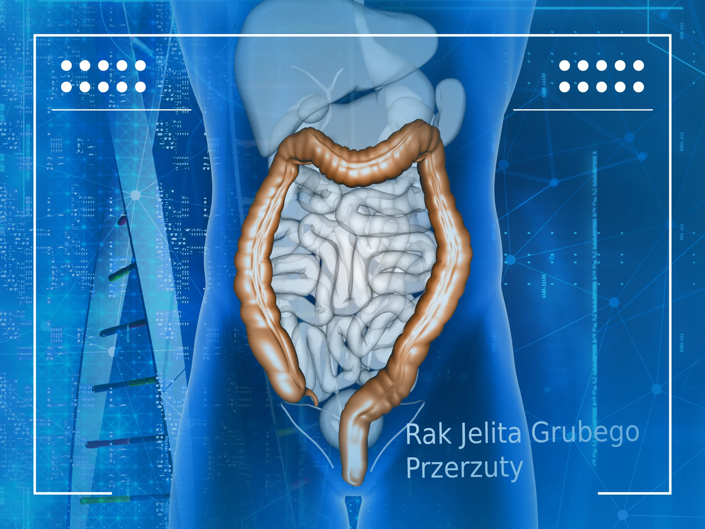 Rak Jelita Grubego Przerzuty Rak Jelita Grubego W W z ach Ch onnych