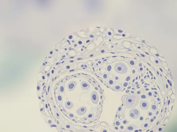 Oral Epithelial Dysplasia