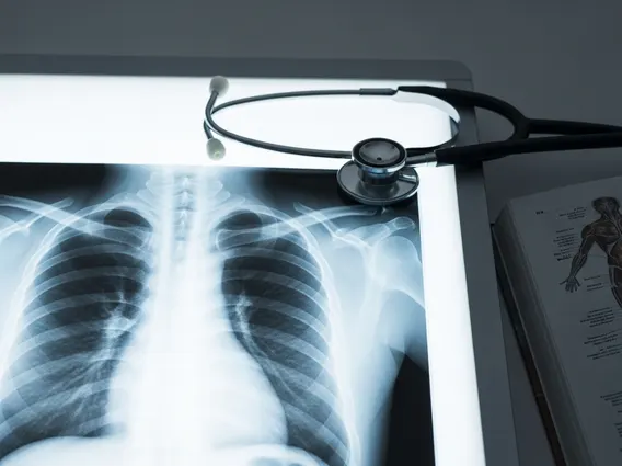 Malignant Pleural Effusion