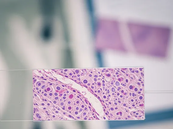 Infiltrating Lobular Carcinoma