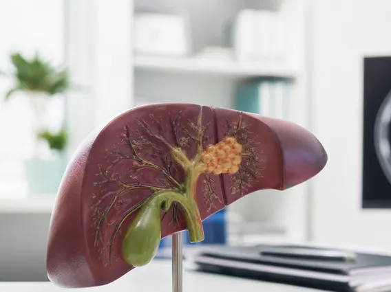 Klatskin Tumor