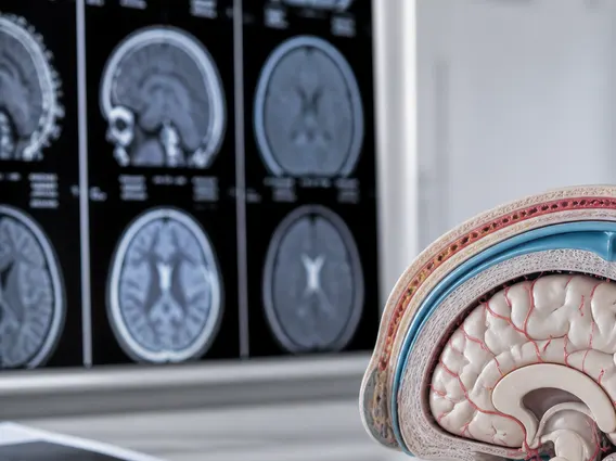 Leptomeningeal Carcinomatosis