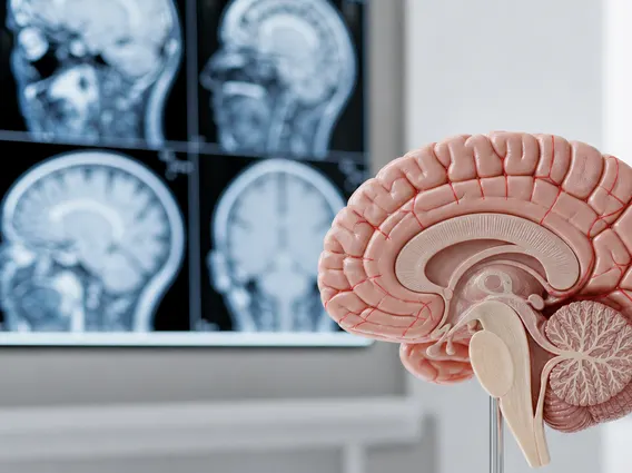 Leptomeningeal