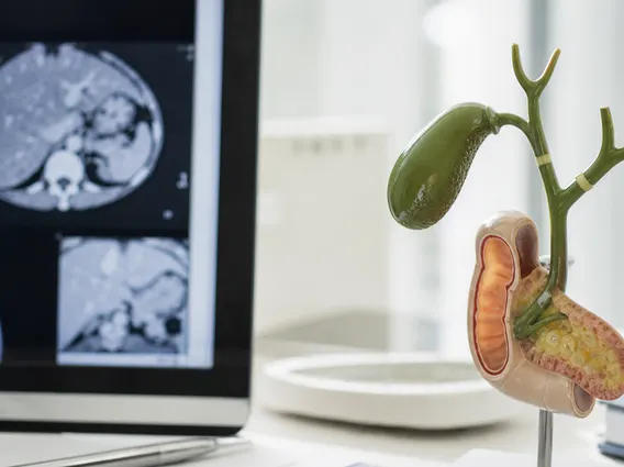Stage Ii Perihilar Bile Duct Cancer