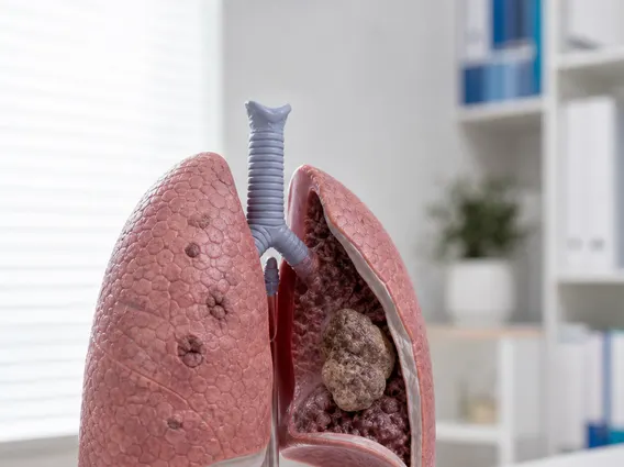 Stage Iii Malignant Pleural Mesothelioma